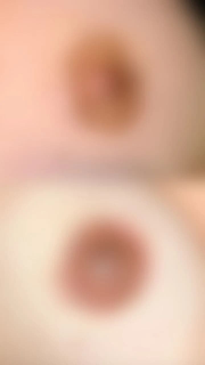 Resultado paramedical (areola)